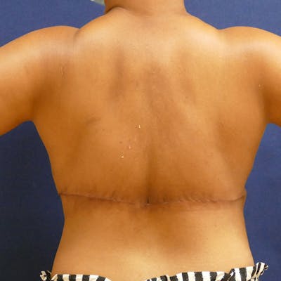 Back Lift Before & After Gallery - Patient 412887 - Image 2