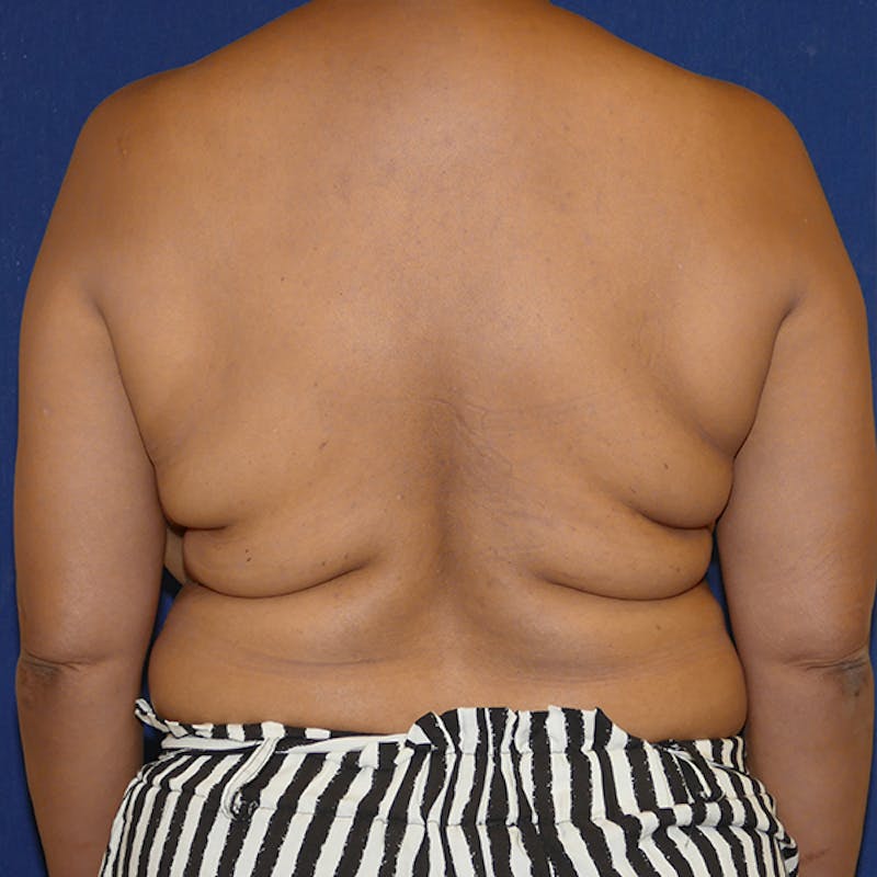 Back Lift Before & After Gallery - Patient 412887 - Image 3