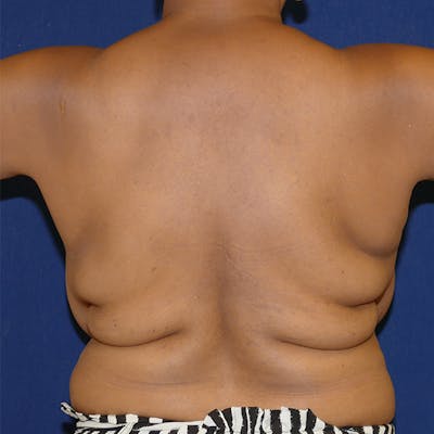 Back Lift Before & After Gallery - Patient 412887 - Image 1