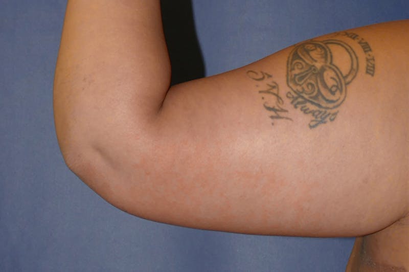 Arm Lift (Brachioplasty) Before & After Gallery - Patient 824518 - Image 8