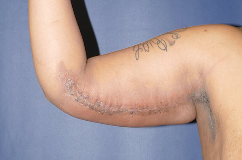 Arm Lift (Brachioplasty) Before & After Gallery - Patient 824518 - Image 6