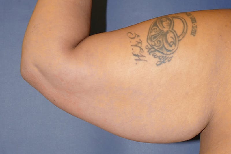 Arm Lift (Brachioplasty) Before & After Gallery - Patient 824518 - Image 7