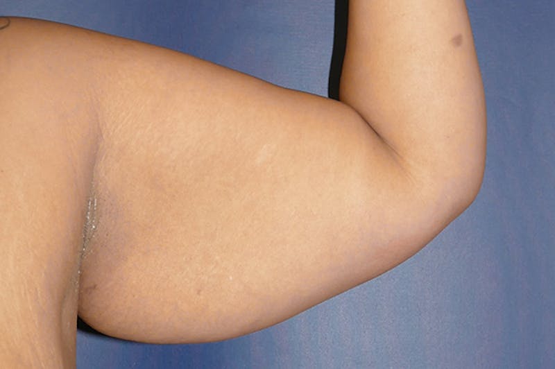 Arm Lift (Brachioplasty) Before & After Gallery - Patient 824518 - Image 3
