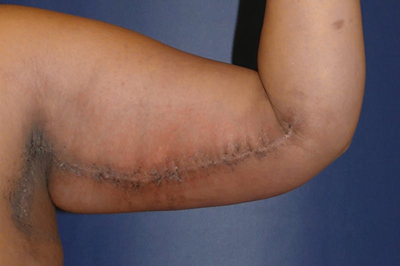 Arm Lift (Brachioplasty) Before & After Gallery - Patient 824518 - Image 4