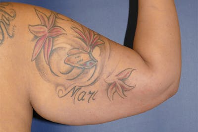 Arm Lift (Brachioplasty) Before & After Gallery - Patient 824518 - Image 1
