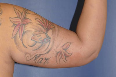 Arm Lift (Brachioplasty) Before & After Gallery - Patient 824518 - Image 2