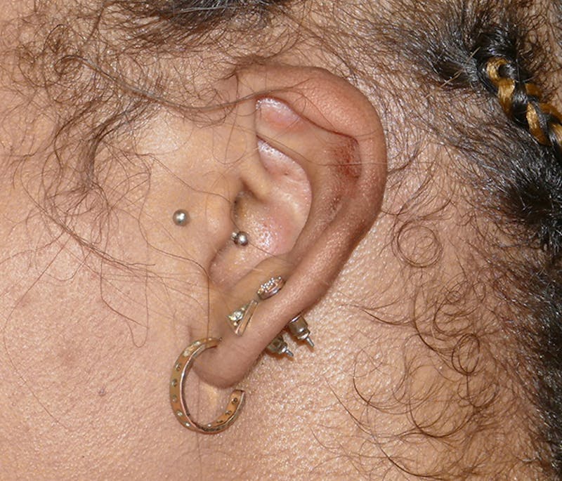 Miscellaneous Before & After Gallery - Patient 373334 - Image 4