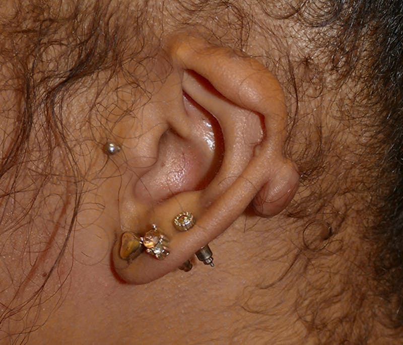 Miscellaneous Before & After Gallery - Patient 373334 - Image 3