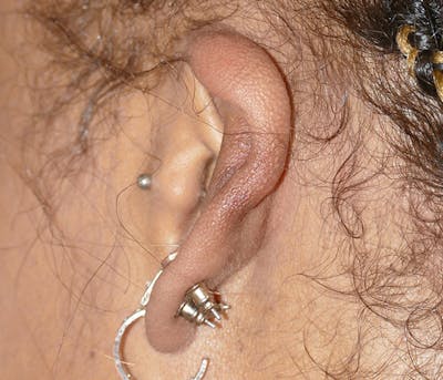 Miscellaneous Before & After Gallery - Patient 373334 - Image 2