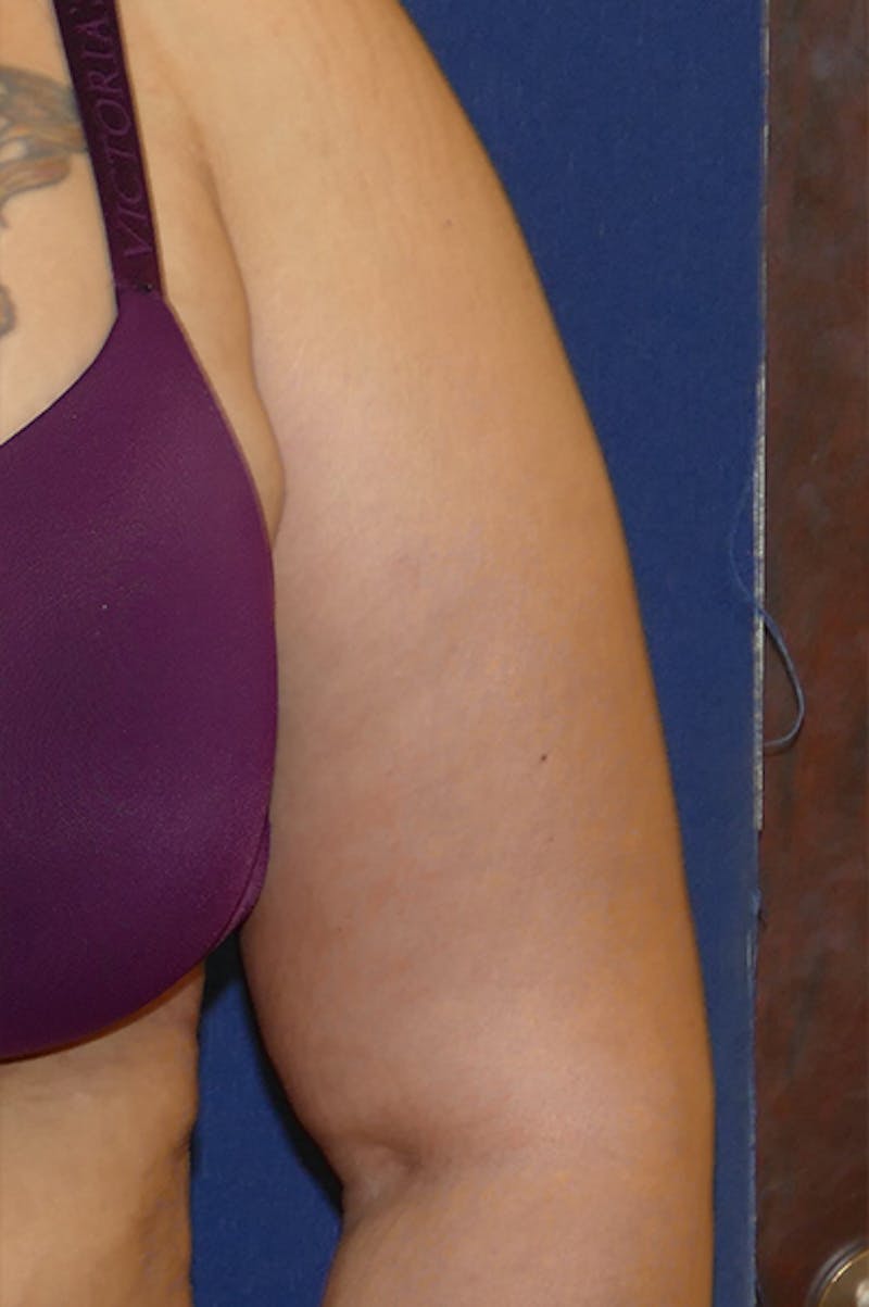Arm Lift (Brachioplasty) Before & After Gallery - Patient 373532 - Image 10