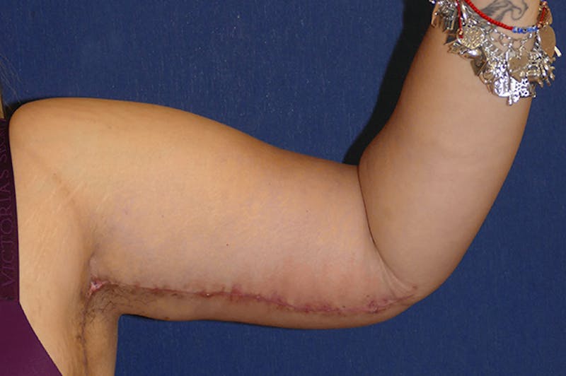 Arm Lift (Brachioplasty) Before & After Gallery - Patient 373532 - Image 8