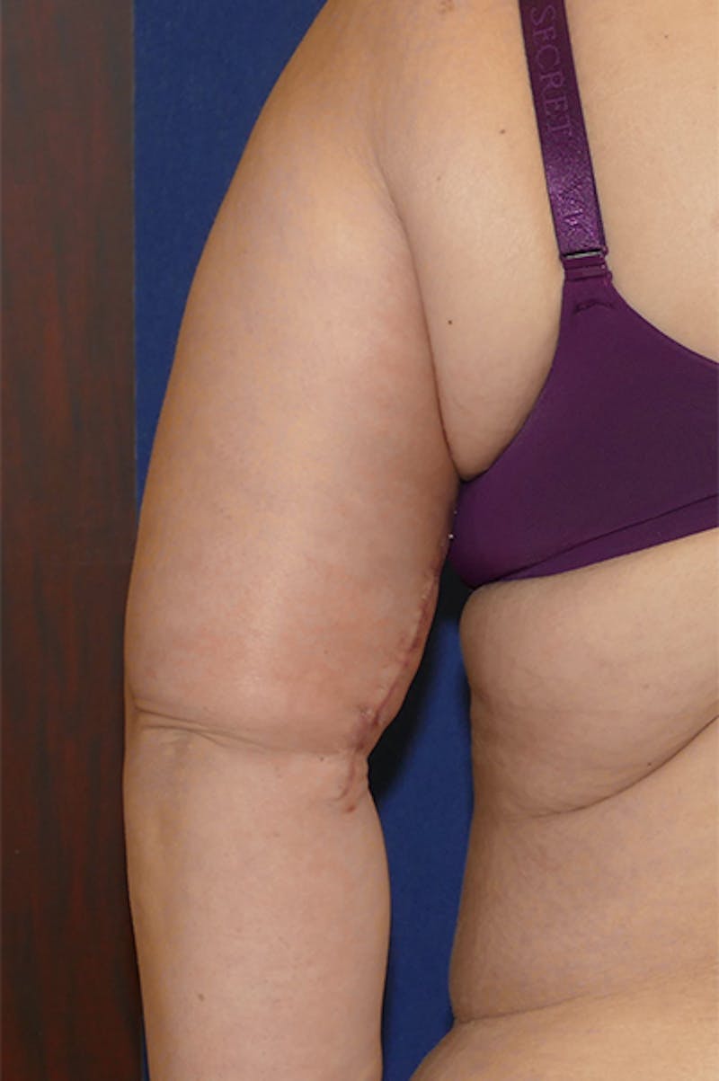 Arm Lift (Brachioplasty) Before & After Gallery - Patient 373532 - Image 9