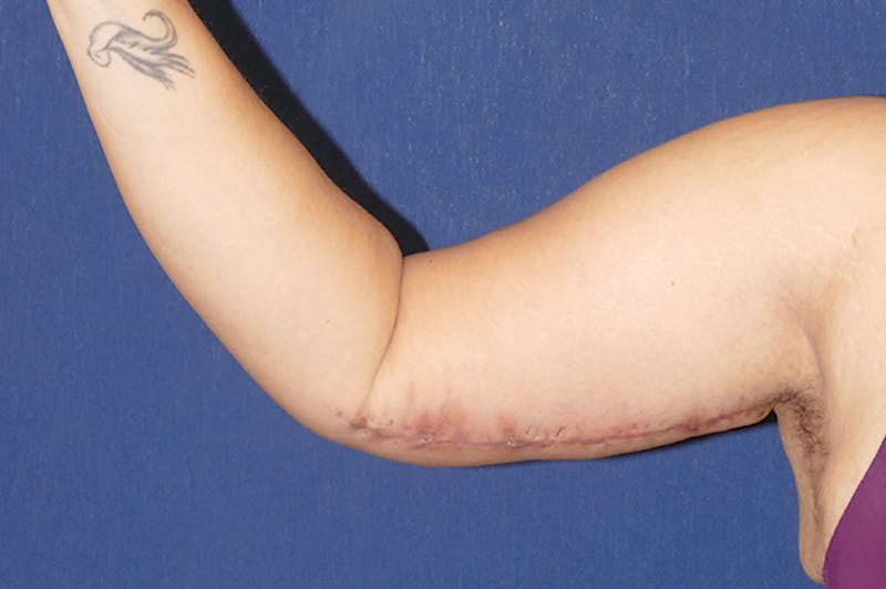 Arm Lift (Brachioplasty) Before & After Gallery - Patient 373532 - Image 6