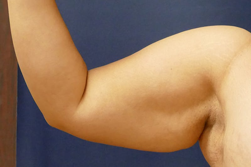 Arm Lift (Brachioplasty) Before & After Gallery - Patient 373532 - Image 5
