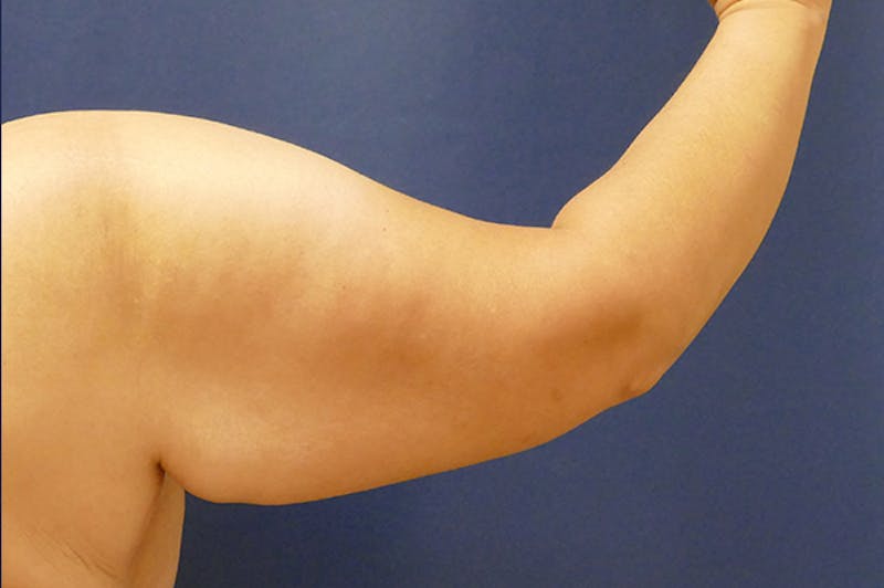 Arm Lift (Brachioplasty) Before & After Gallery - Patient 373532 - Image 3
