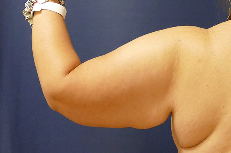 Arm Lift (Brachioplasty) Before & After Gallery - Patient 373532 - Image 1