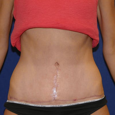 Tummy Tuck (Abdominoplasty) Before & After Gallery - Patient 258599 - Image 2
