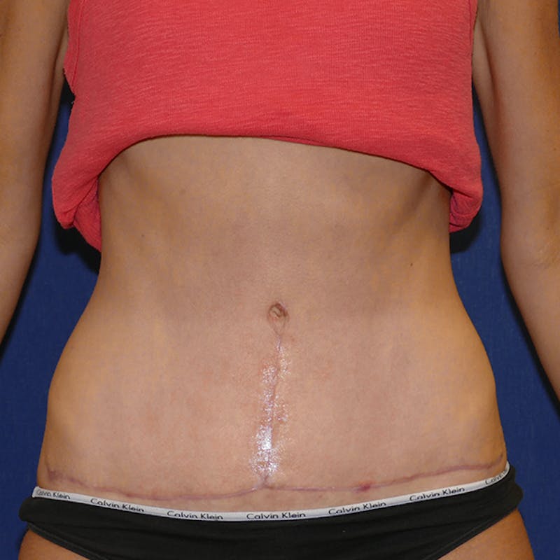 Tummy Tuck (Abdominoplasty) Before & After Gallery - Patient 258599 - Image 2