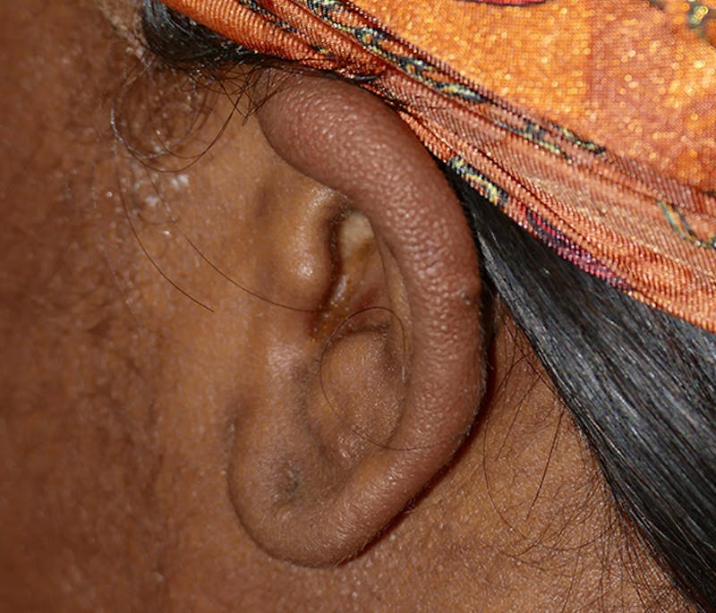 Miscellaneous Before & After Gallery - Patient 338871 - Image 4
