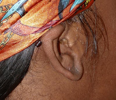 Miscellaneous Before & After Gallery - Patient 338871 - Image 2