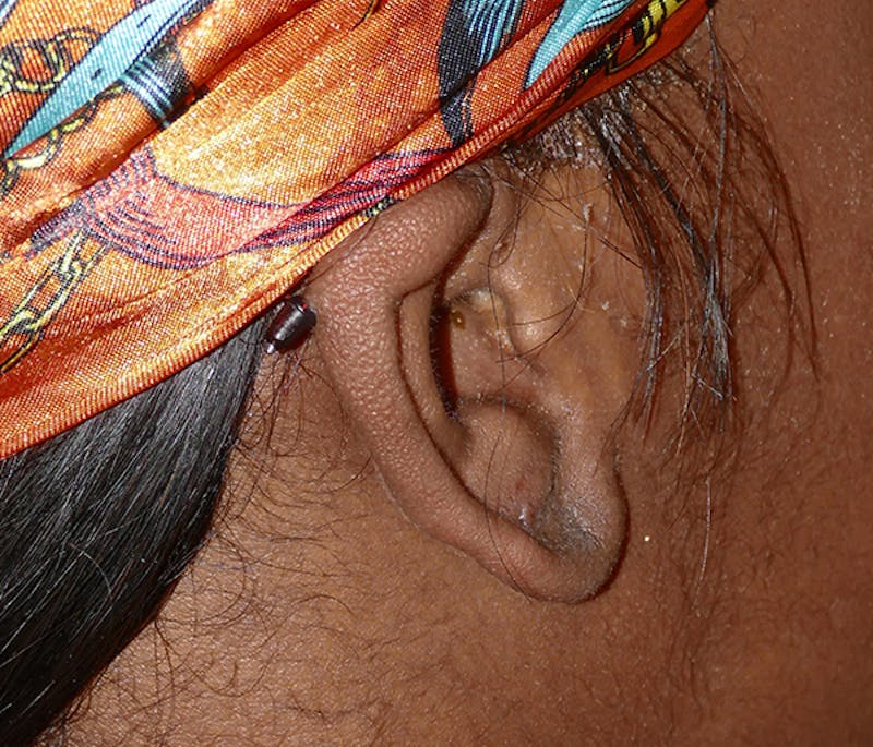 Miscellaneous Before & After Gallery - Patient 338871 - Image 2