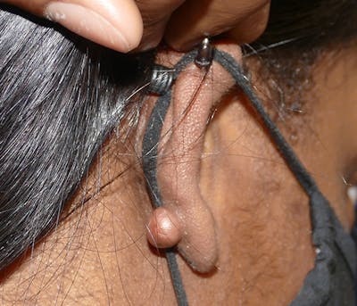 Miscellaneous Before & After Gallery - Patient 338871 - Image 1