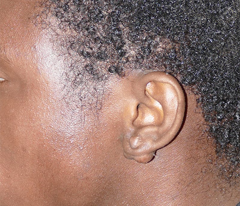 Miscellaneous Before & After Gallery - Patient 195022 - Image 1