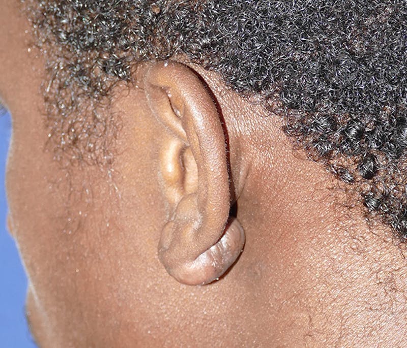 Miscellaneous Before & After Gallery - Patient 195022 - Image 3