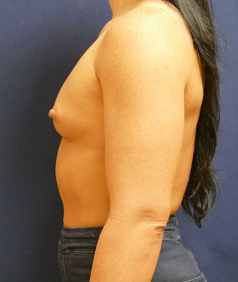 Breast Augmentation Before & After Gallery - Patient 170707 - Image 9