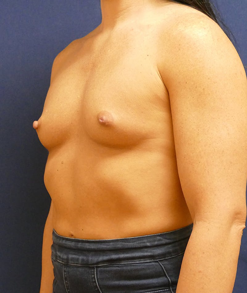 Breast Augmentation Before & After Gallery - Patient 170707 - Image 7
