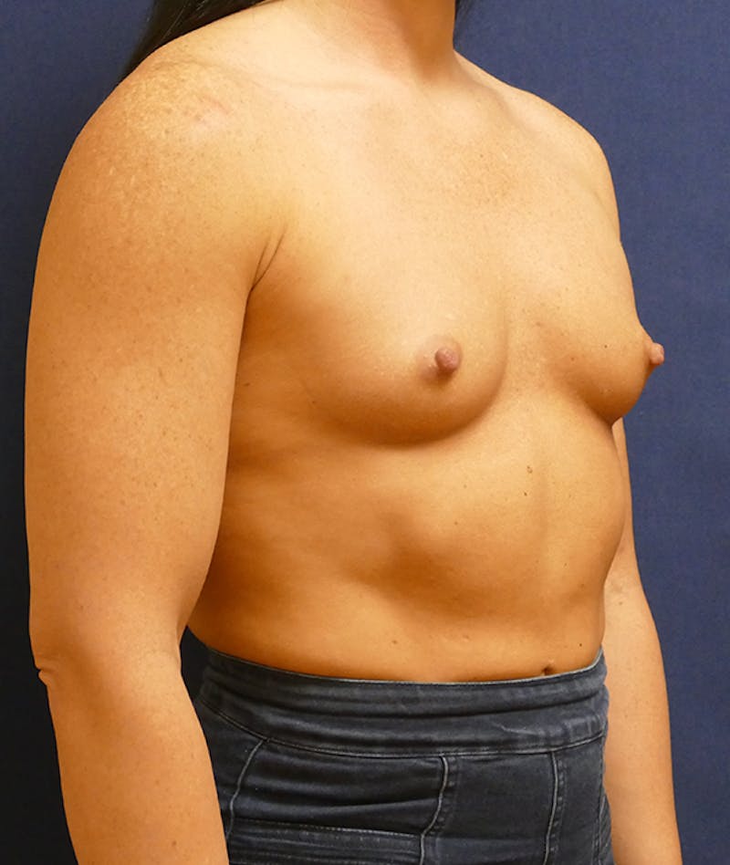Breast Augmentation Before & After Gallery - Patient 170707 - Image 5