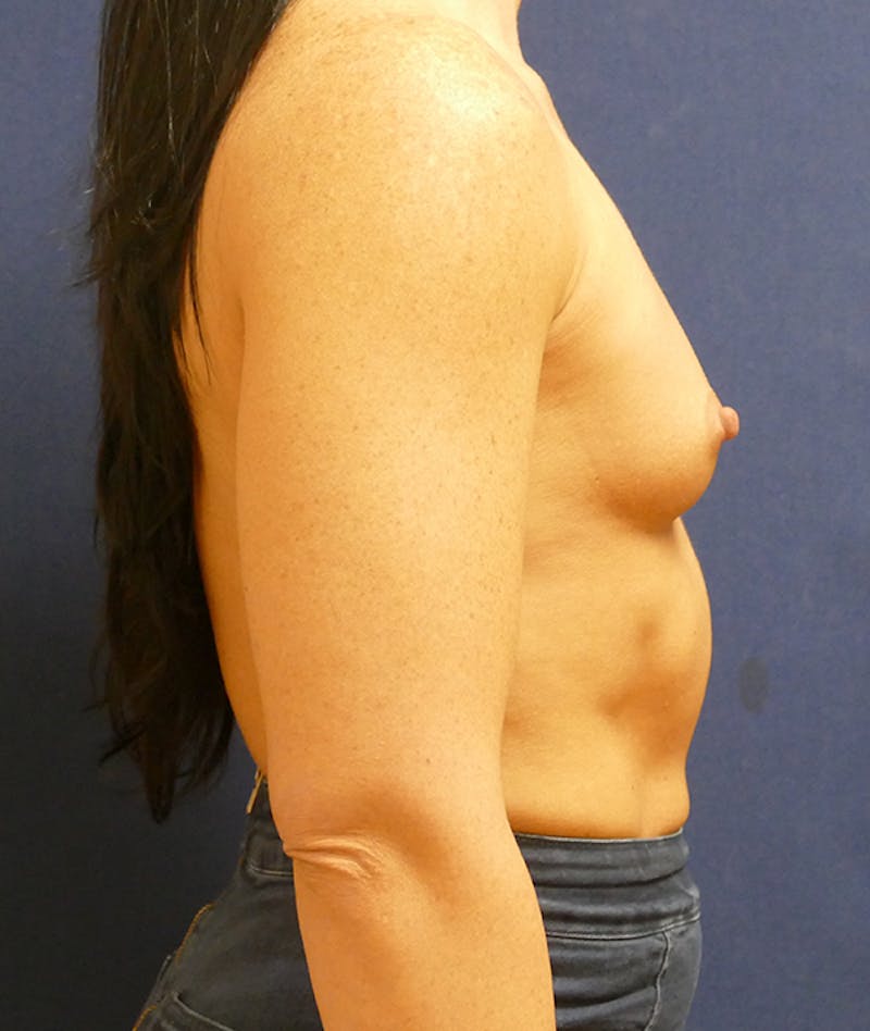 Breast Augmentation Before & After Gallery - Patient 170707 - Image 3