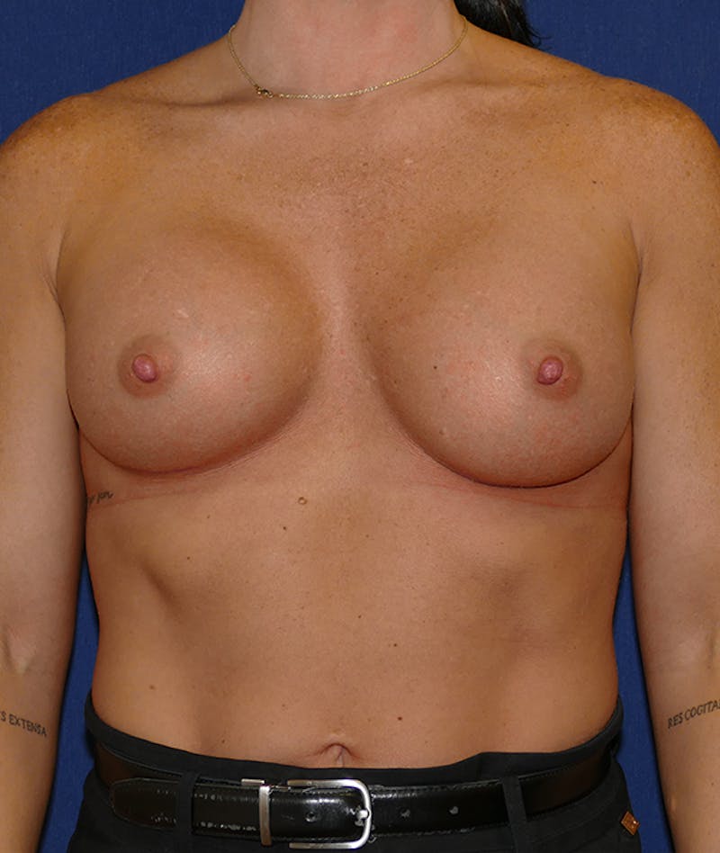 Breast Augmentation Before & After Gallery - Patient 170707 - Image 2