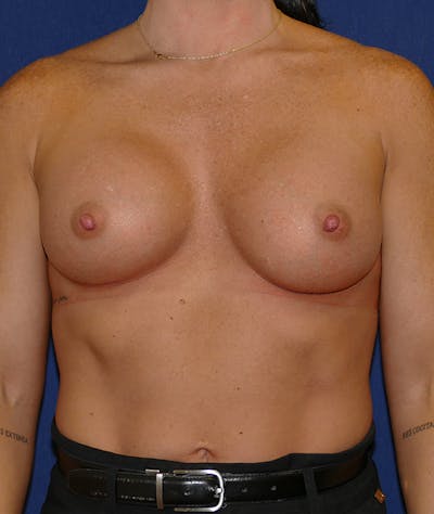 Breast Augmentation Before & After Gallery - Patient 170707 - Image 2
