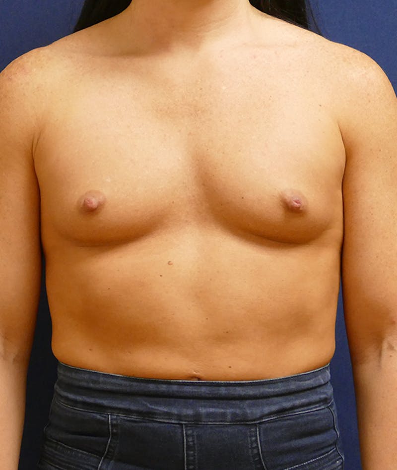 Breast Augmentation Before & After Gallery - Patient 170707 - Image 1