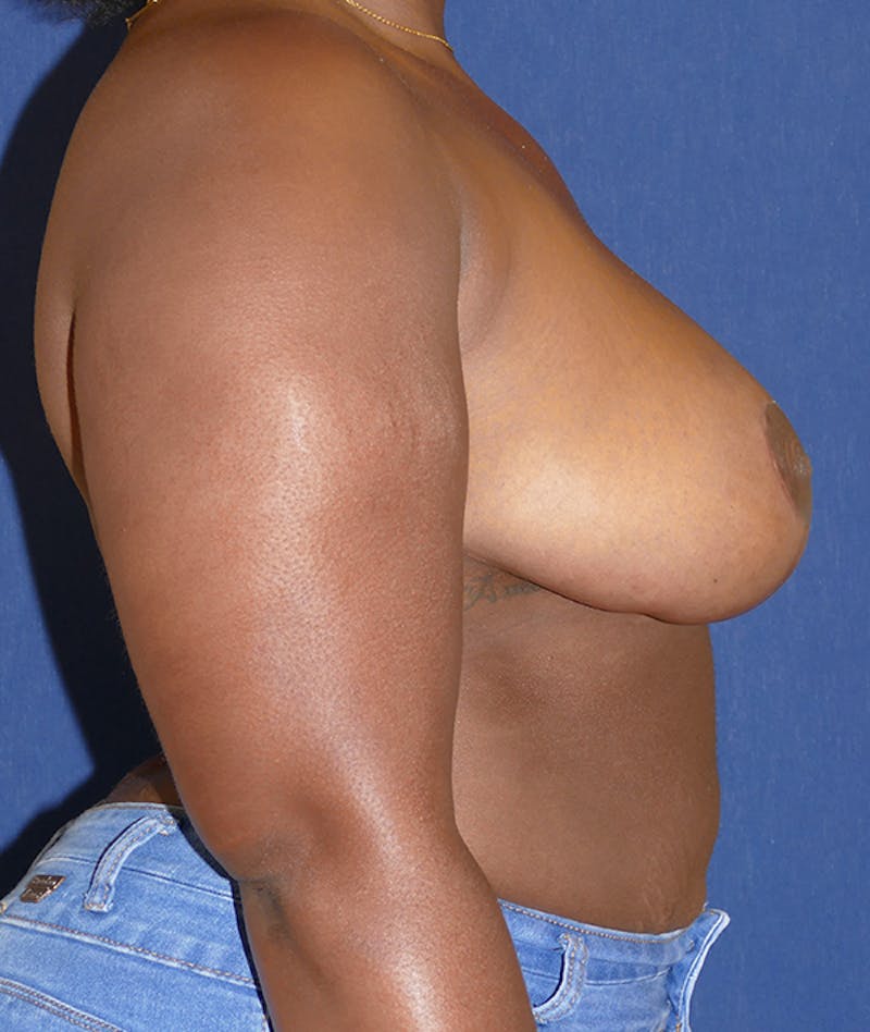 Breast Reduction Before & After Gallery - Patient 495311 - Image 6