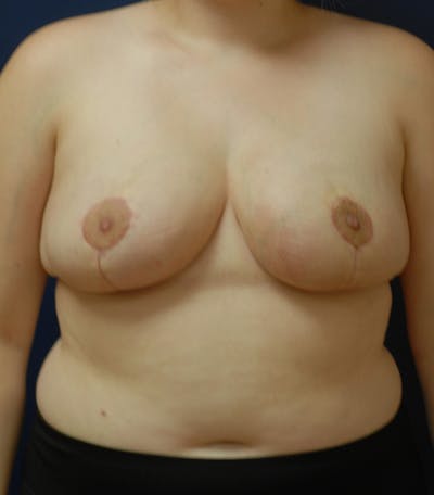 Breast Reduction Before & After Gallery - Patient 124493 - Image 2