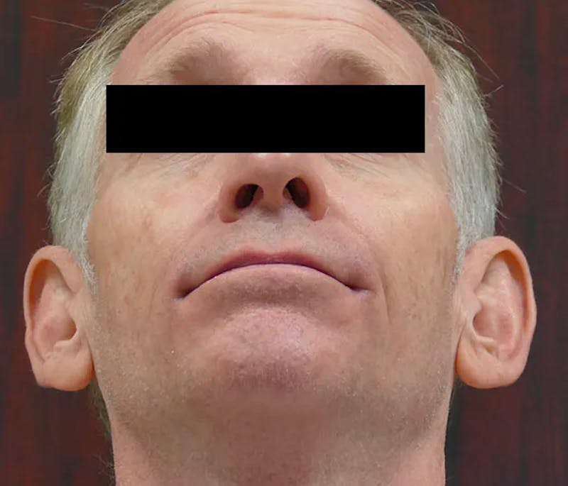 Ear Pinning (Otoplasty) Before & After Gallery - Patient 328485 - Image 7