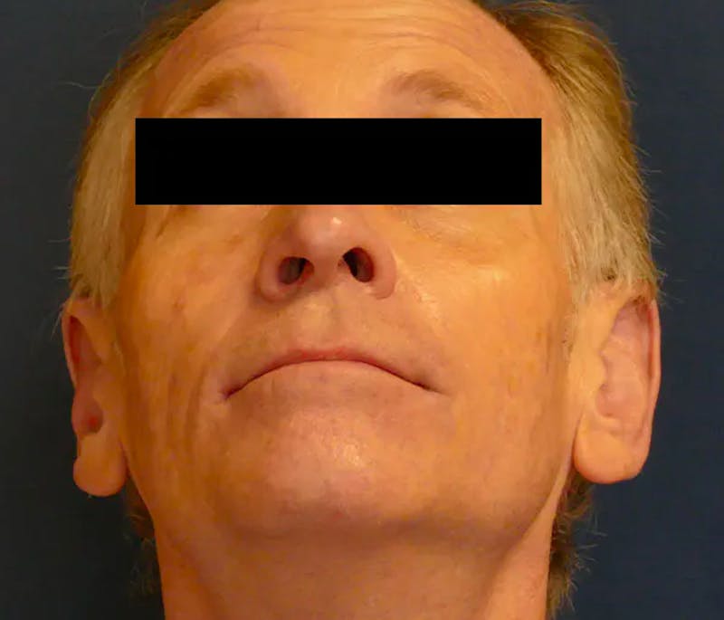 Ear Pinning (Otoplasty) Before & After Gallery - Patient 328485 - Image 8