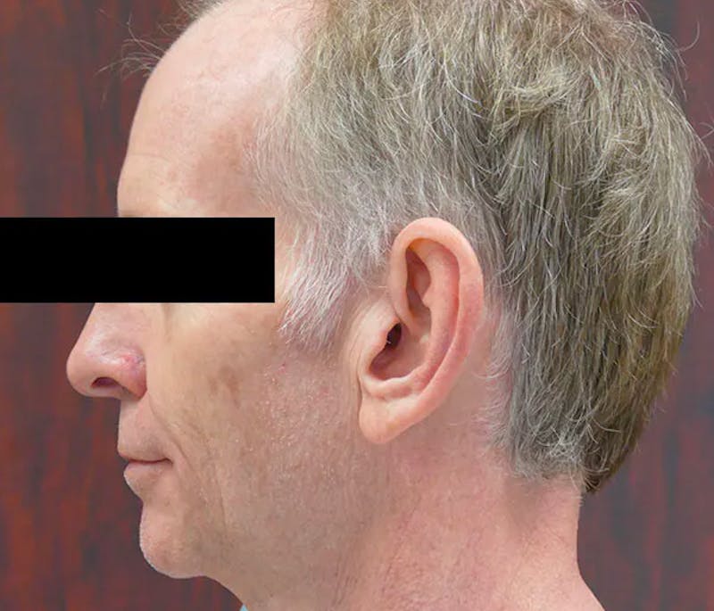 Ear Pinning (Otoplasty) Before & After Gallery - Patient 328485 - Image 5