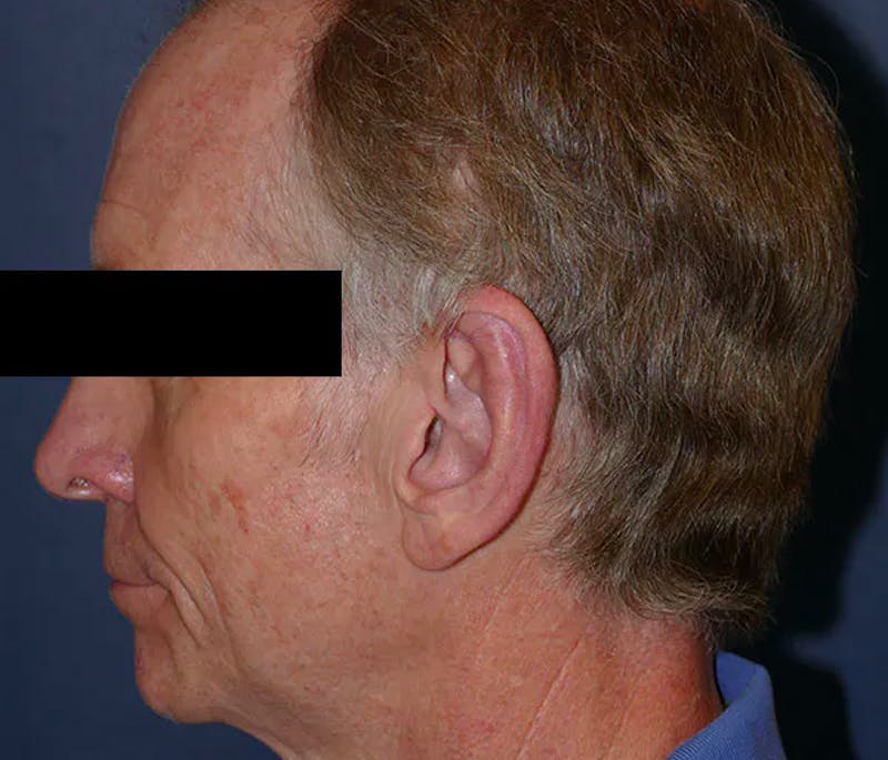 Ear Pinning (Otoplasty) Before & After Gallery - Patient 328485 - Image 6