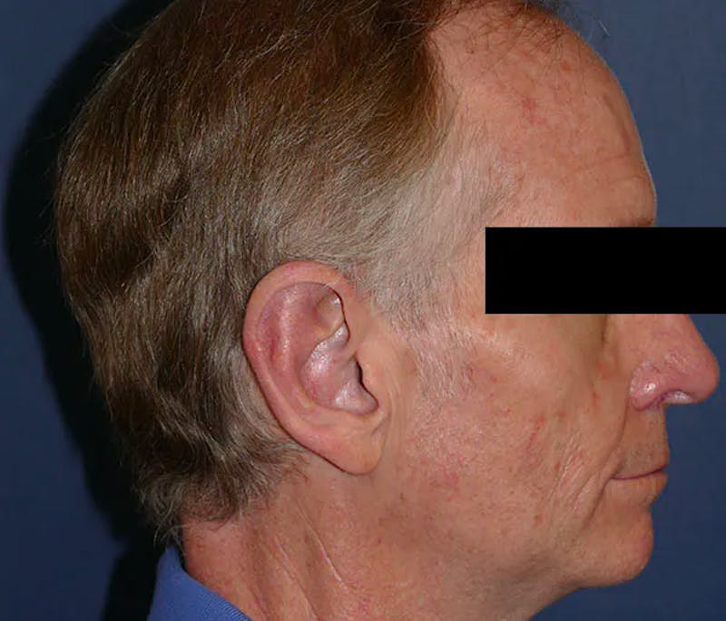 Ear Pinning (Otoplasty) Before & After Gallery - Patient 328485 - Image 4
