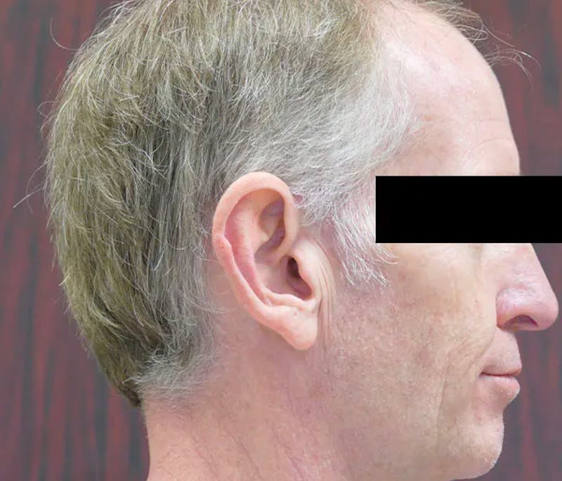 Ear Pinning (Otoplasty) Before & After Gallery - Patient 328485 - Image 3