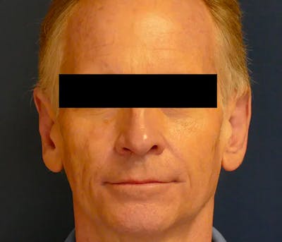 Ear Pinning (Otoplasty) Before & After Gallery - Patient 328485 - Image 2