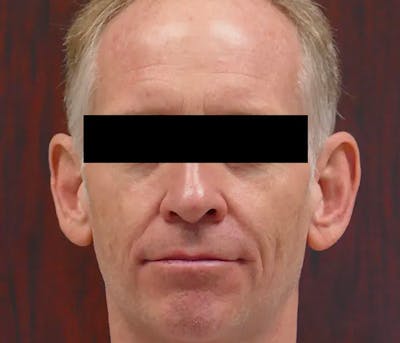 Ear Pinning (Otoplasty) Before & After Gallery - Patient 328485 - Image 1