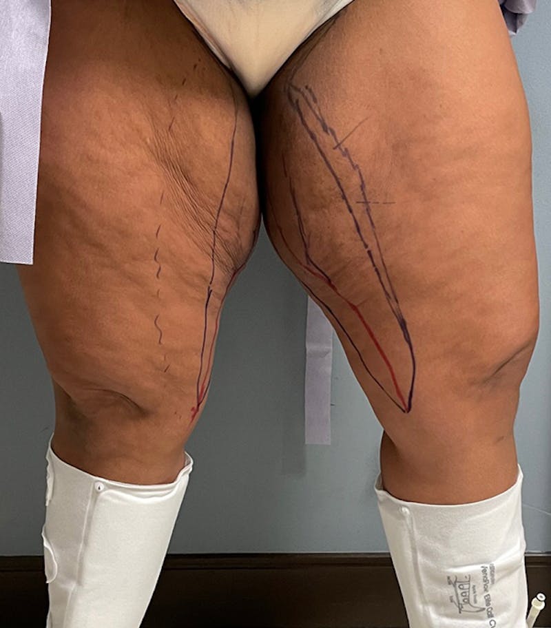 Thigh Lift Before & After Gallery - Patient 329620 - Image 7