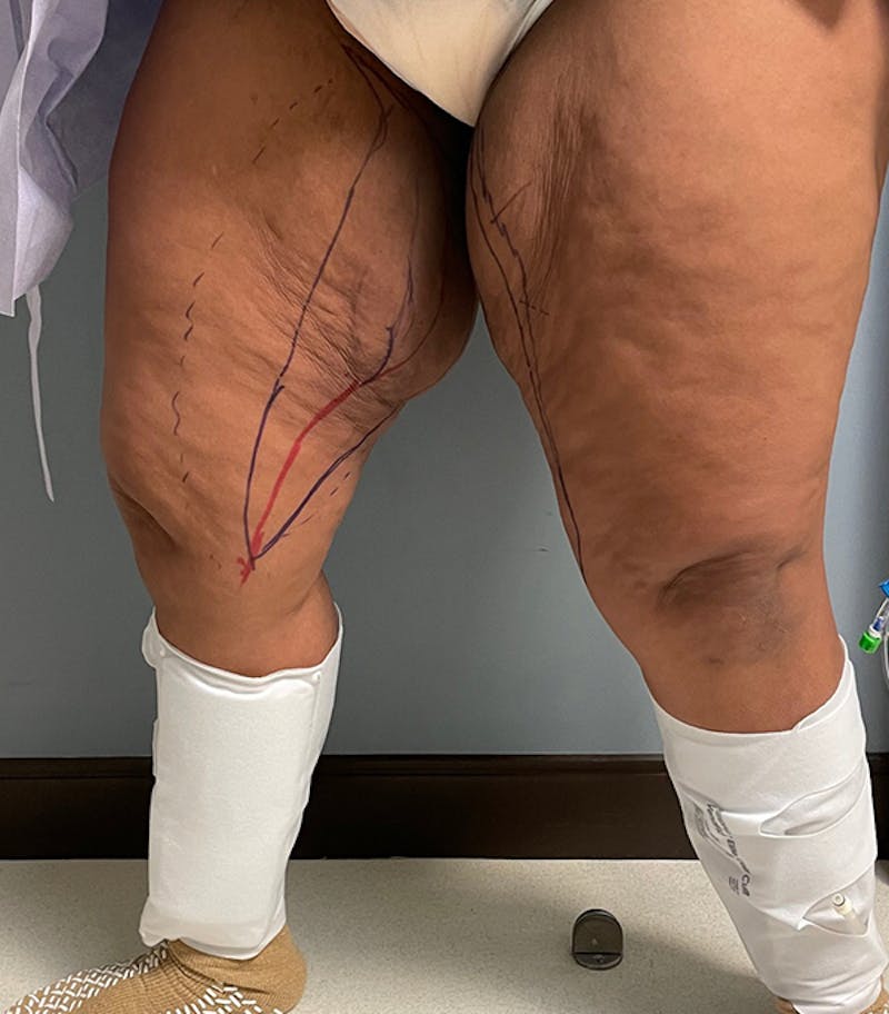Thigh Lift Before & After Gallery - Patient 329620 - Image 5
