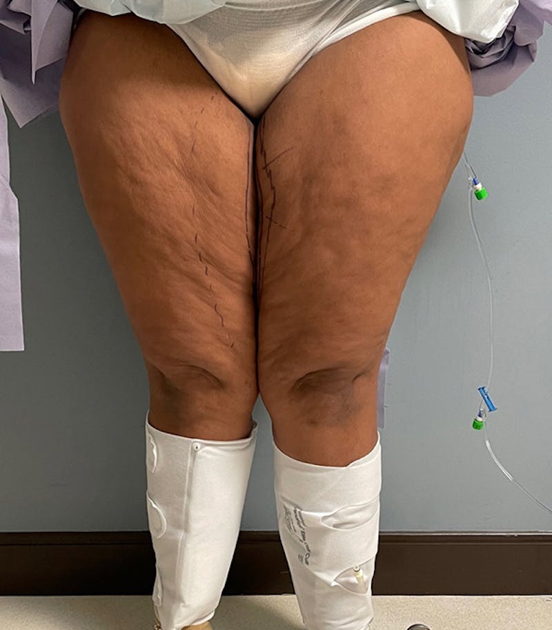 Thigh Lift Before & After Gallery - Patient 329620 - Image 3