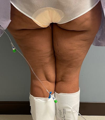 Thigh Lift Before & After Gallery - Patient 329620 - Image 1