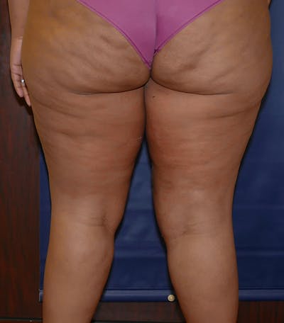 Thigh Lift Before & After Gallery - Patient 329620 - Image 2